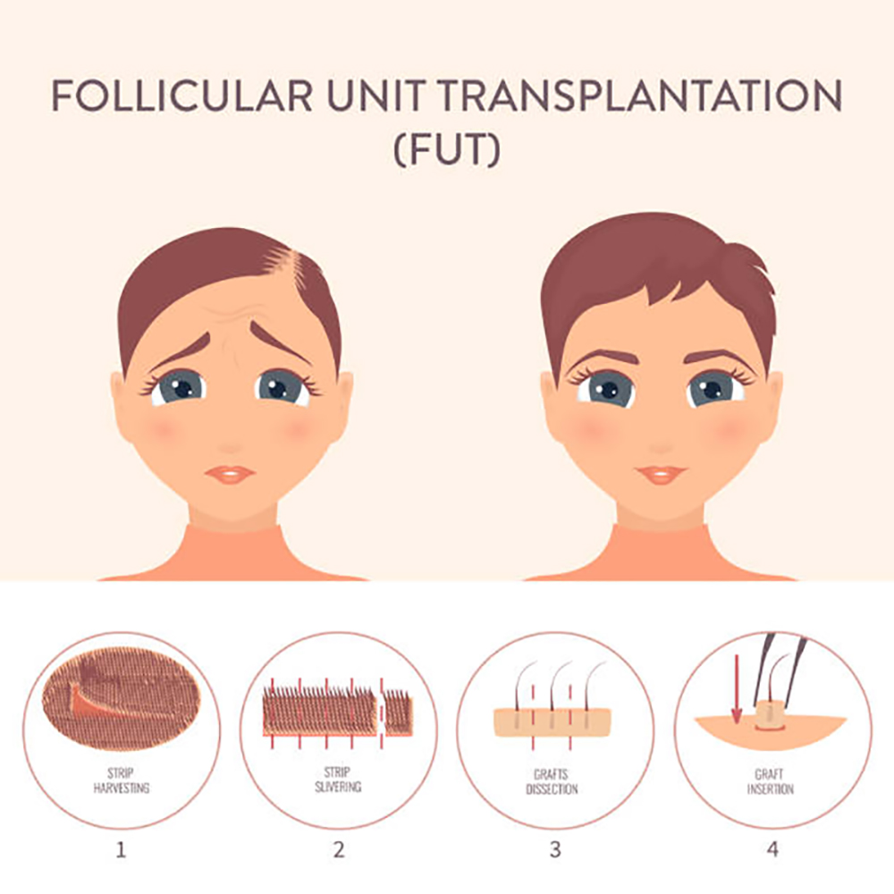 Learn how a Hair Transplant Surgeon Can Help You